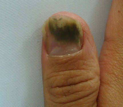 зеленое пятно на ногте