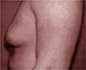 Гинекомастия или мужская женская грудь