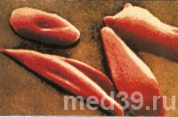 серповидноклеточная анемия