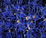 Ученые разработали простое  решение для диагностики болезни Альцгеймера