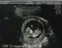 беременность 12 недель