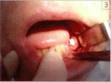 Остеоматрикс при хирургическом лечении радикулярных кист челюстей